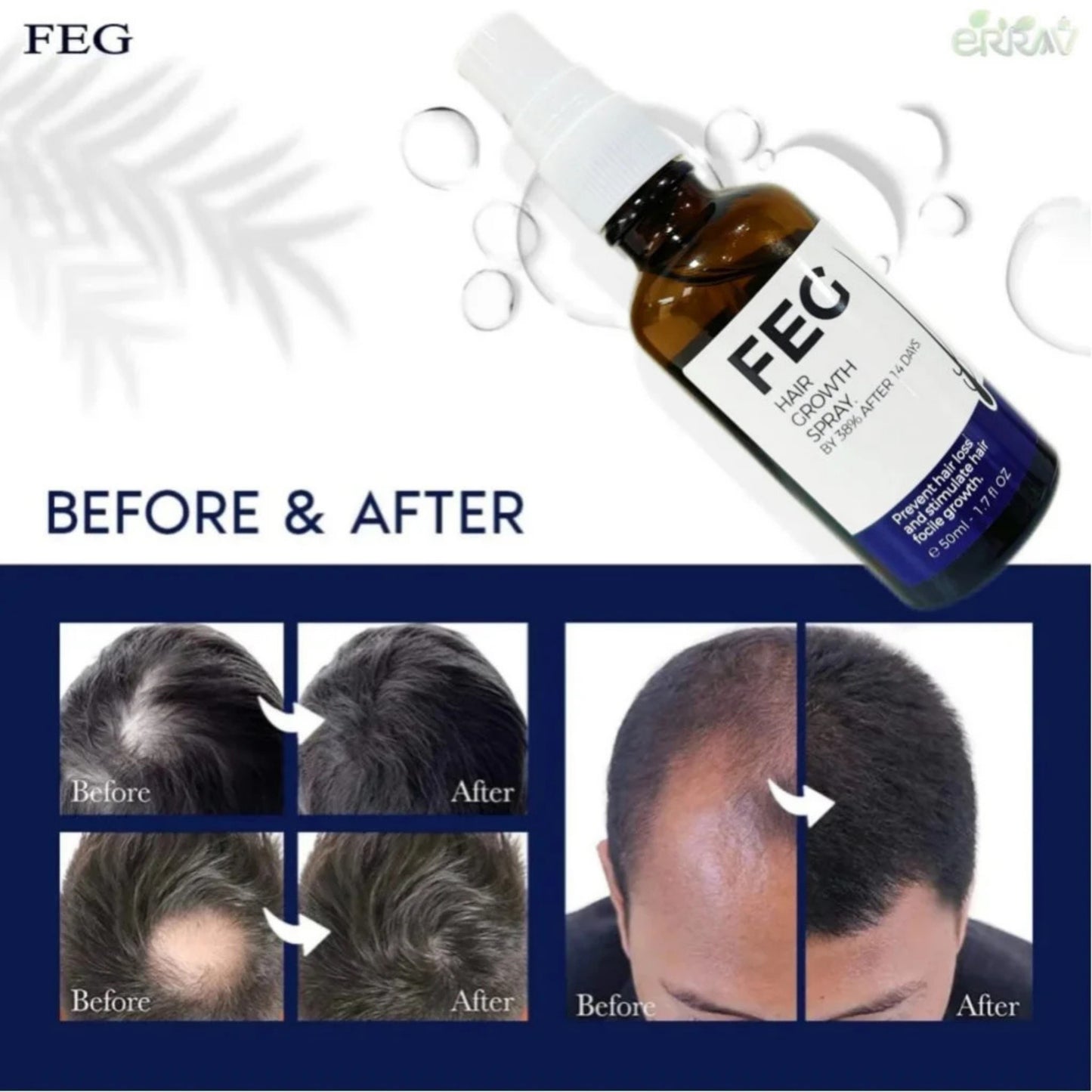 FEGPLUS Minoxidil Beard & Hair Growth Serum Kit with Roller